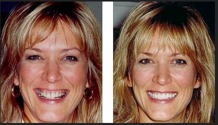 Gummy Smile